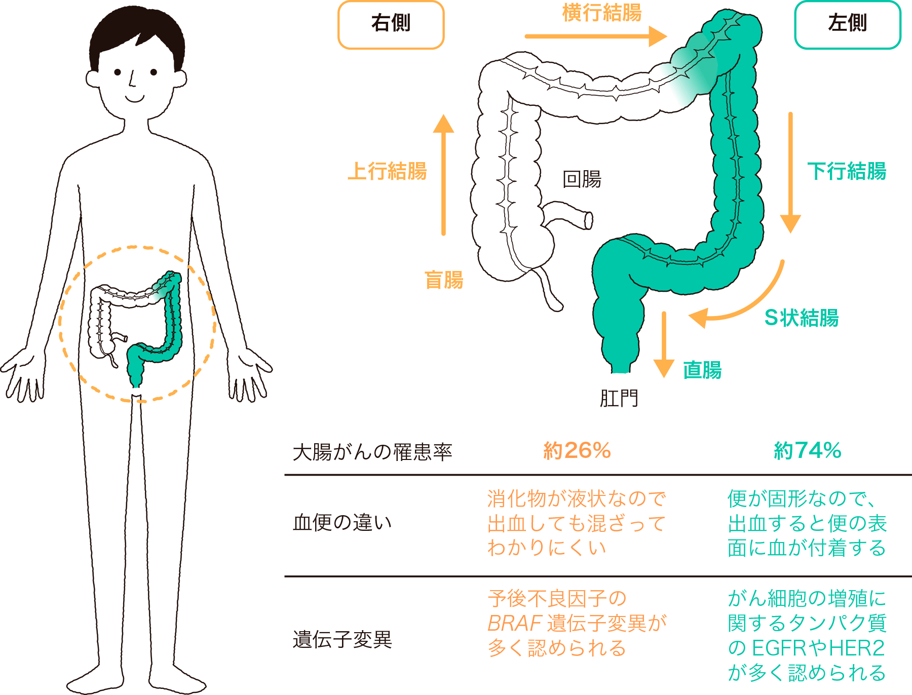 横行結腸、下行結腸、S状結腸、直腸、盲腸、上行結腸など大腸がんの右側がんと左側がんによる血便の違いや遺伝子変異の違い