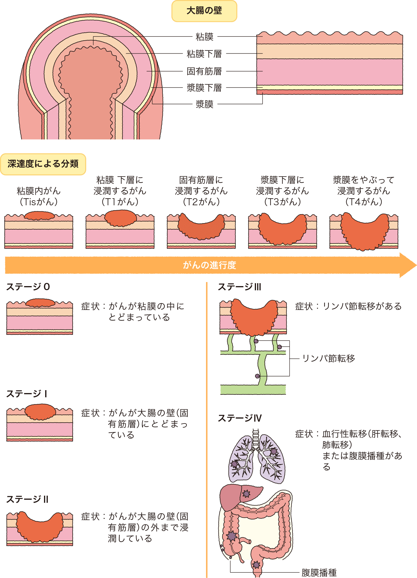 大腸の壁の構造・深達度（粘膜内がん、粘膜下層に浸潤するがん、固有筋層に浸潤するがん、漿膜下層に浸潤するがん、漿膜をやぶって浸潤するがん）による分類・大腸がんの進行度