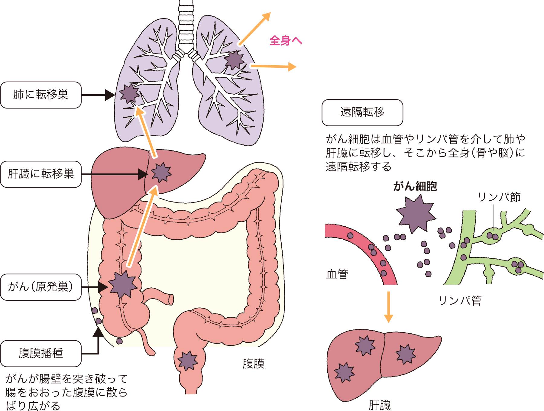 大腸がんのステージⅣにおけるがんが転移する場所と遠隔転移について。肺、肝臓、腹膜播種への転移、遠隔転移。