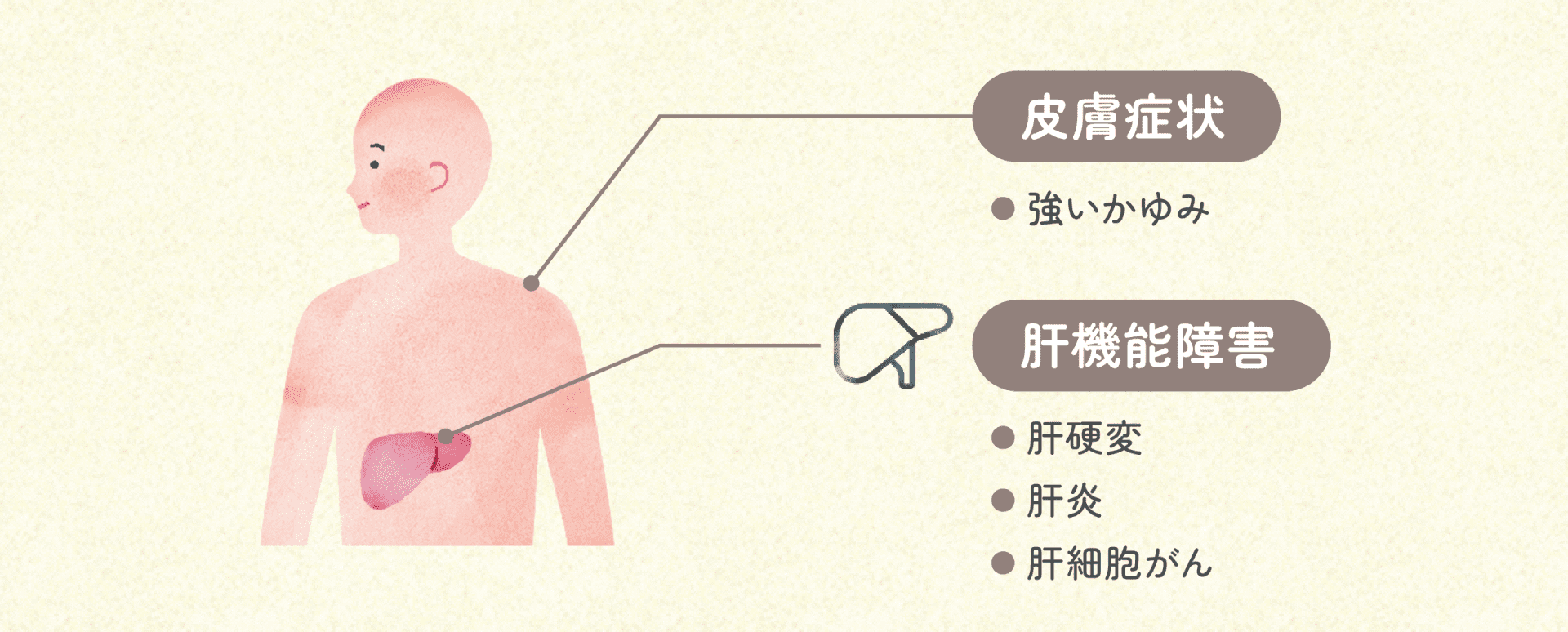 皮膚症状 強いかゆみ 肝機能障害 肝硬変 肝炎 肝細胞がん