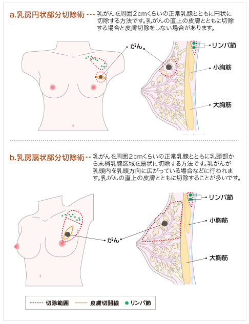 a.乳房円状部分切除術b.乳房扇状部分切除術