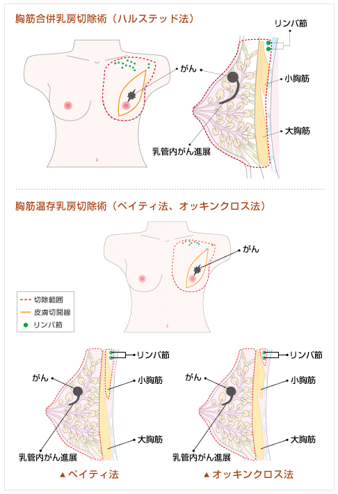 胸筋合併乳房切除術（ハルステッド法）。胸筋温存乳房切除術（ペイティ法、オッキンクロス法）