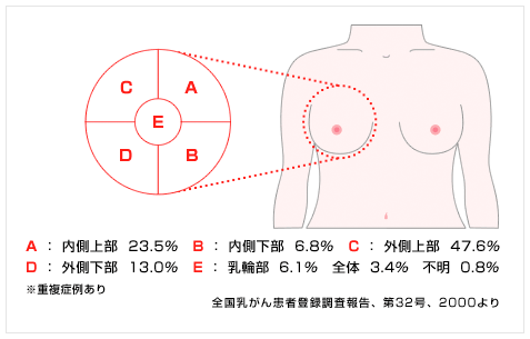 乳がんの発生部位別の頻度イメージ