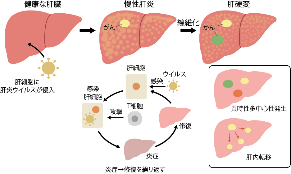 肝細胞がんの発生機序