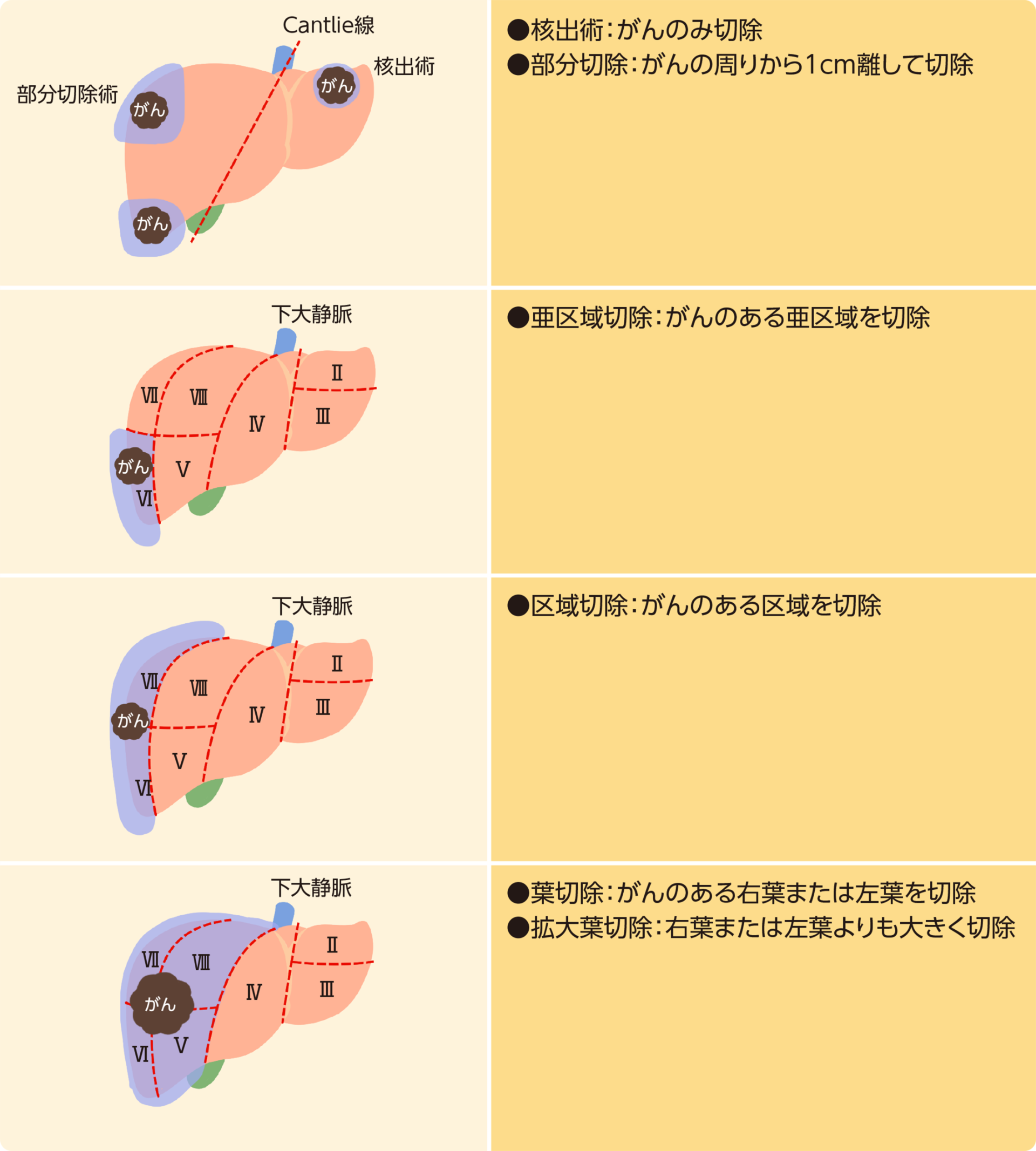 肝切除の術式と切除範囲