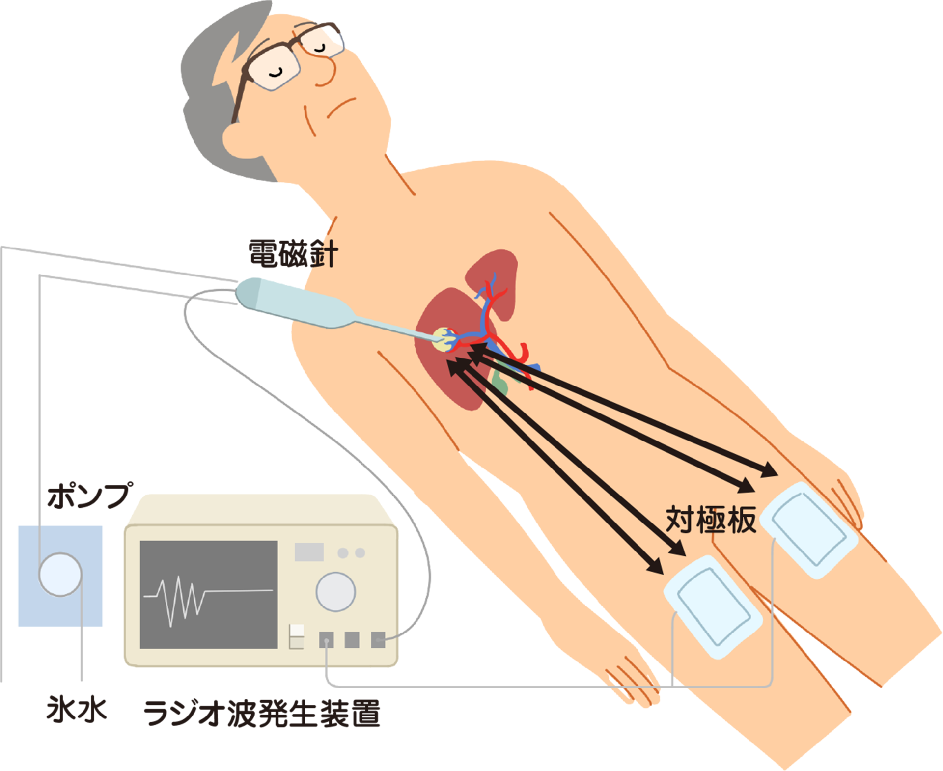 ラジオ波焼灼療法