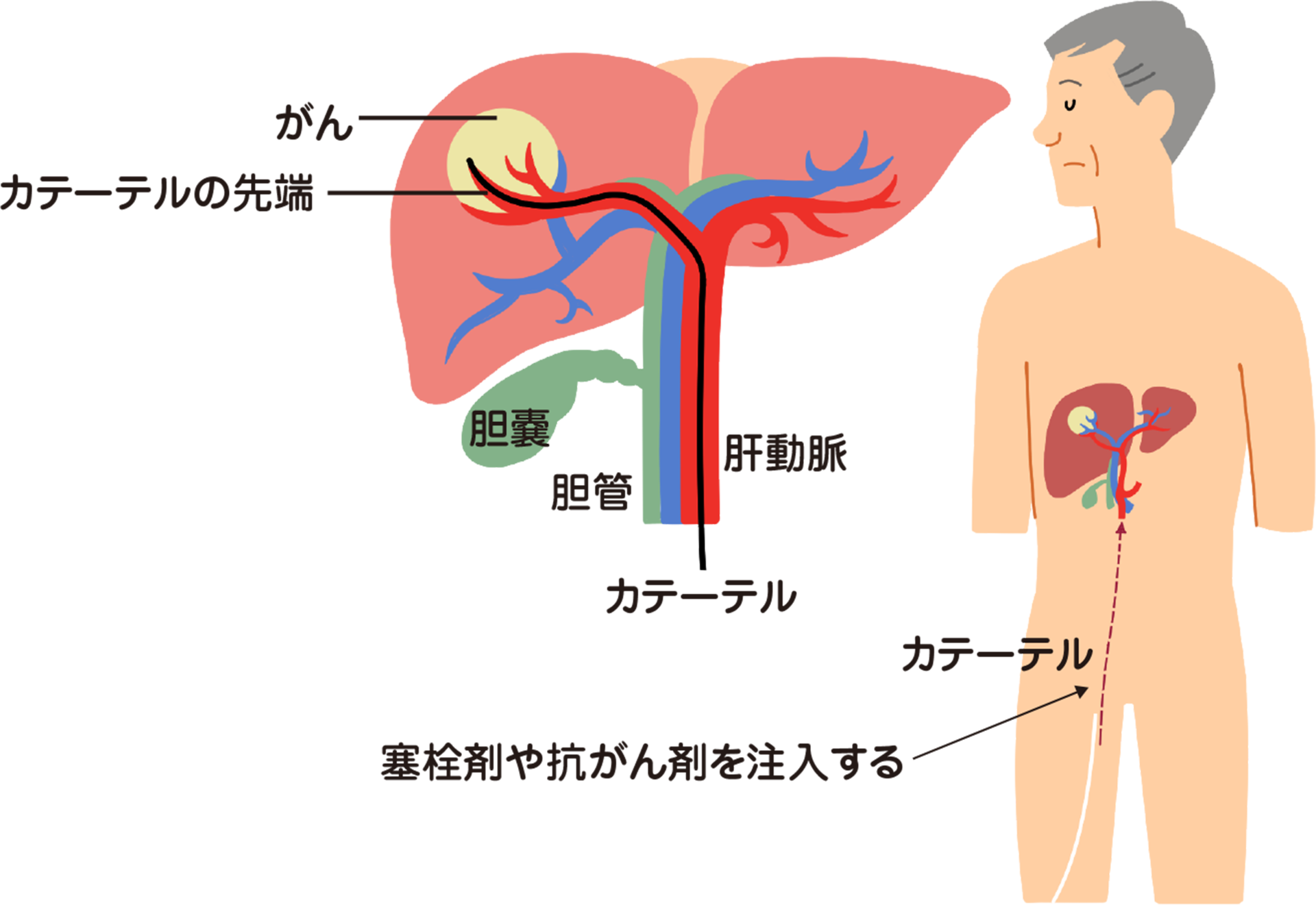 肝動脈化学塞栓療法