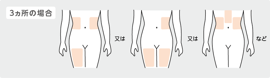 3ヵ所の場合の注射部位イラスト