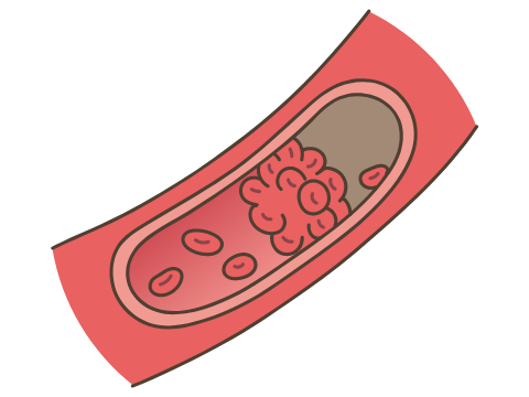 血栓塞栓症イメージ