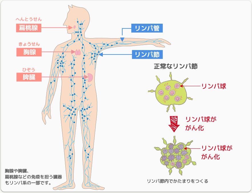 リンパ腫の種類 リンパ腫のお話