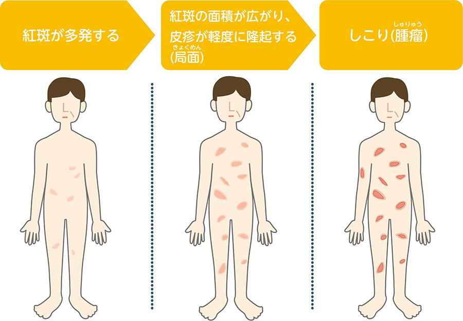 皮膚T細胞リンパ腫で代表的な菌状息肉症の進行経過