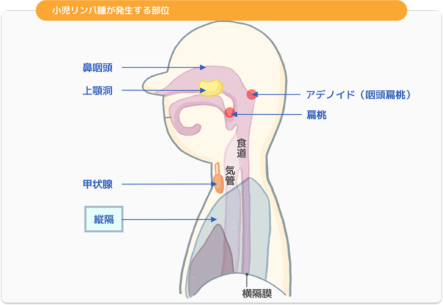 悪性 リンパ腫 初期 症状