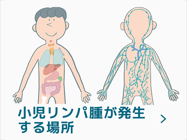 小児リンパ腫が発生する場所