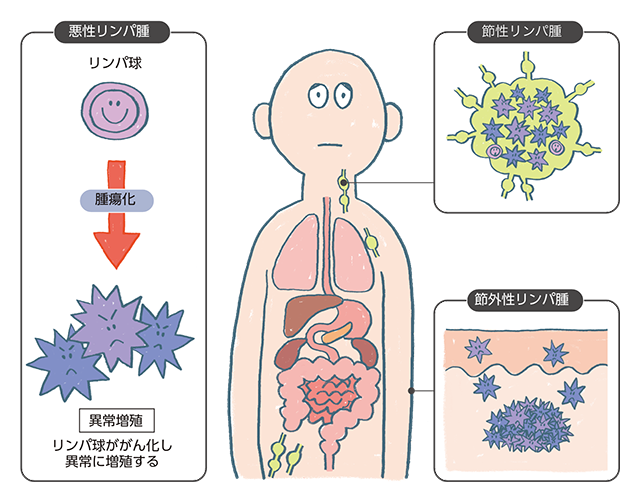 皮膚リンパ腫とは