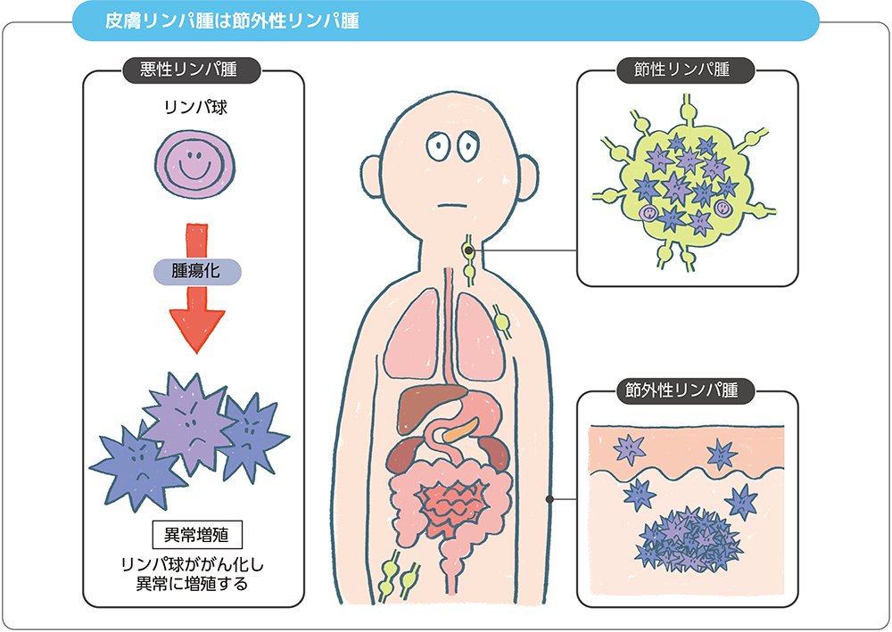 皮膚リンパ腫は節外性リンパ腫