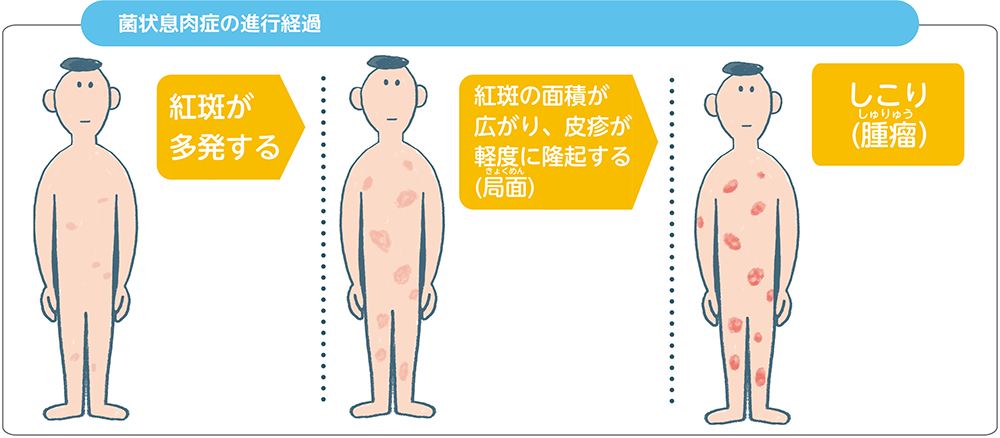 皮膚リンパ腫は節外性リンパ腫