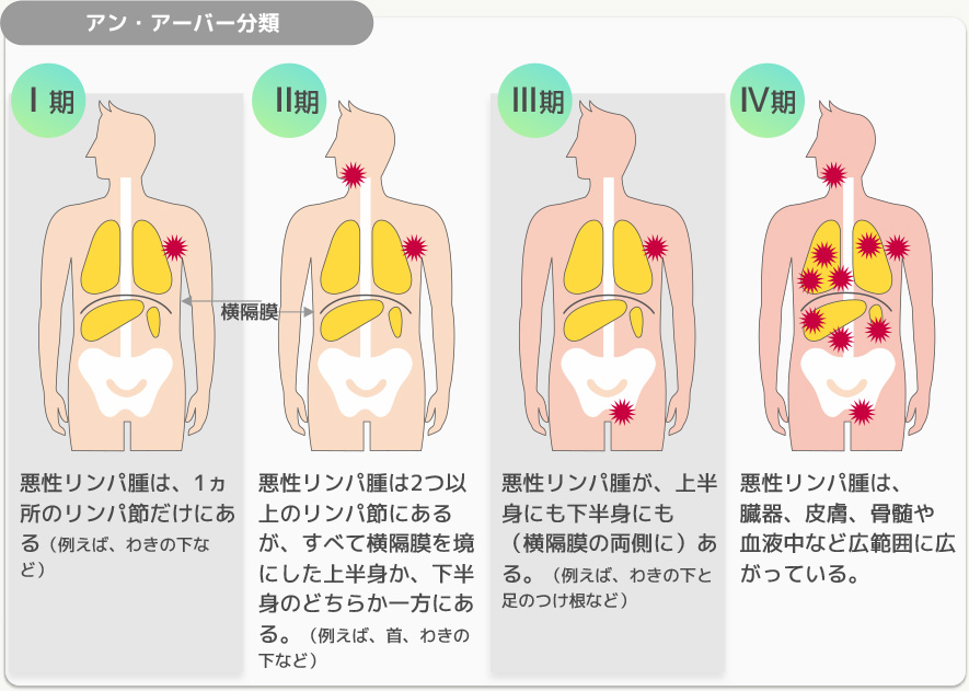 悪性リンパ腫