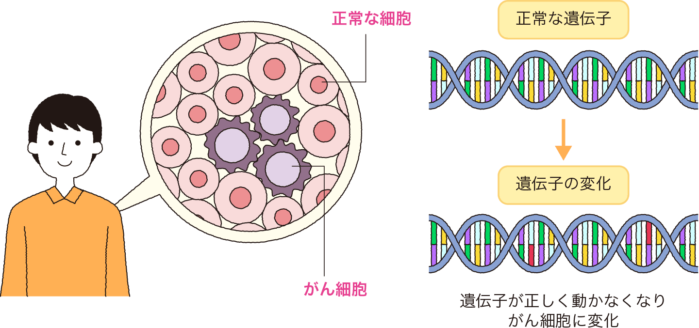 大腸がんの遺伝子の異常とがんの発生の関係