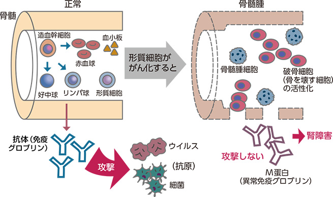 図1 多発性⾻髄腫の病態