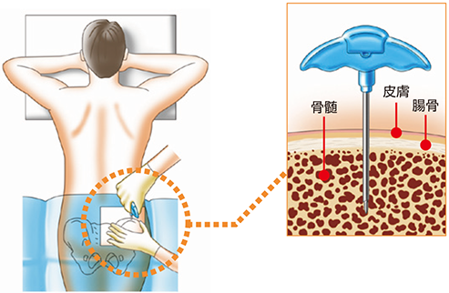 骨髄穿刺と骨髄生検