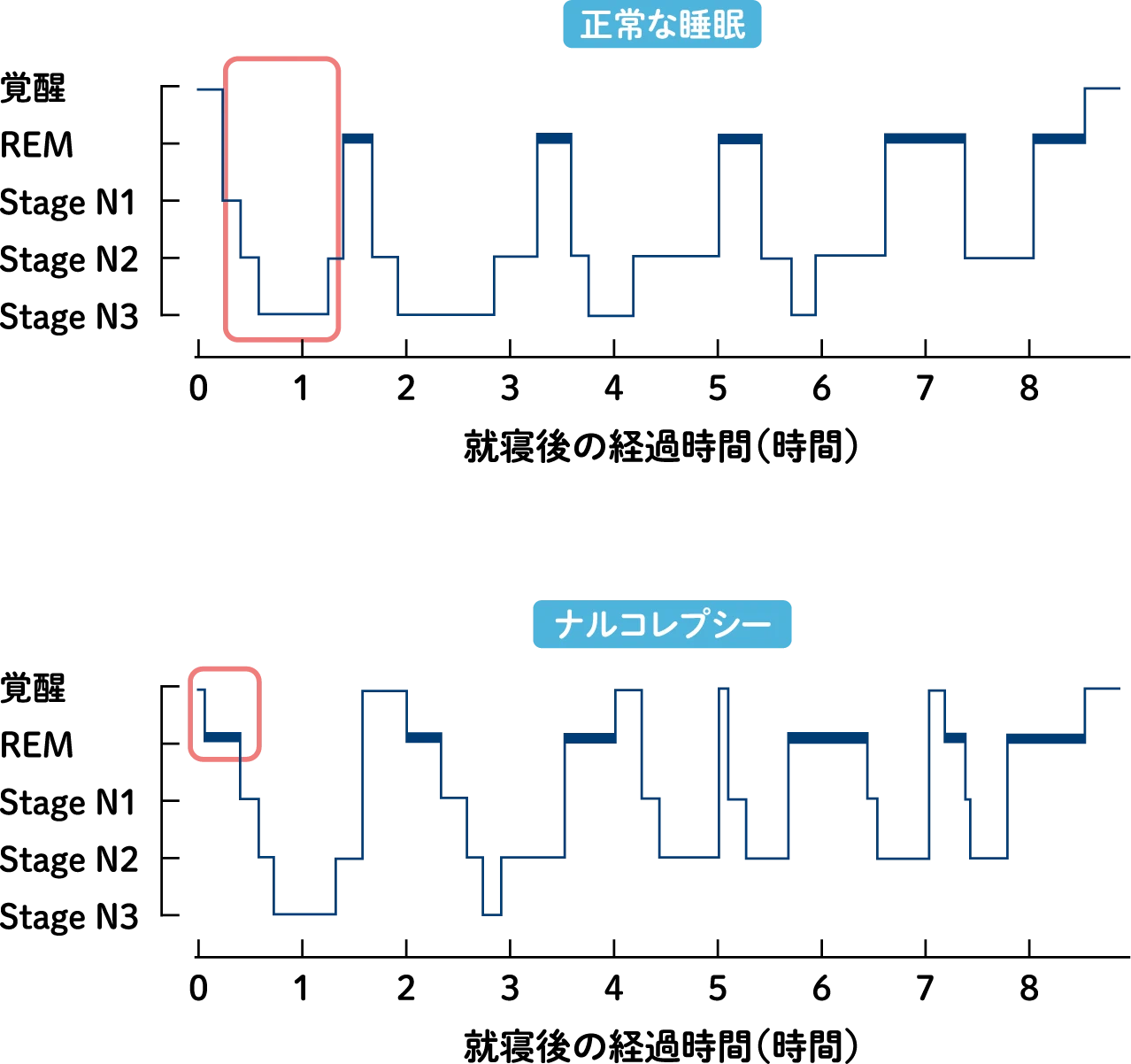 「正常な睡眠」と「ナルコレプシー」の睡眠経過図（ヒプノグラム）を示したグラフです。横軸は「就寝後の経過時間」、縦軸は睡眠段階を示しています。「正常な睡眠」では、就寝後に深いノンレム睡眠を経てからレム睡眠が現れるのに対し、「ナルコレプシー」では、就寝直後にレム睡眠が出現するという特徴的な睡眠パターンが示されています。