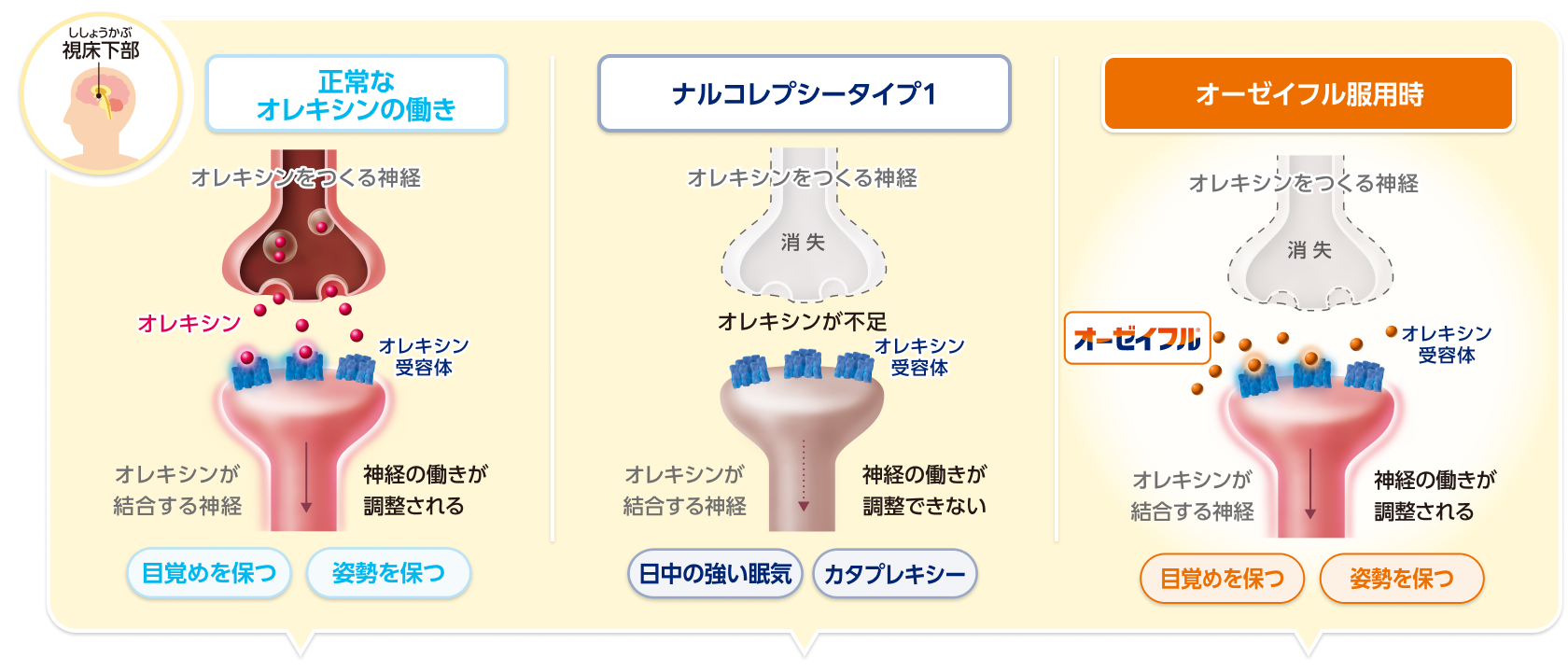 ナルコレプシータイプ1の病態とオーゼイフルの作用