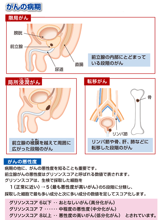 がんの病期