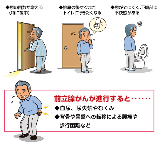 尿の回数が増える。排尿の後すぐまたトイレに行きたくなる。尿がでにくく、下腹部に不快感がある。前立腺がんが進行すると血尿、尿失禁やむくみ、背骨や骨盤への転移による腰痛や歩行困難など。