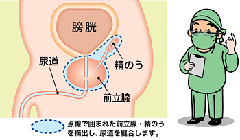 前立腺・精のうを摘出し、尿道を縫合