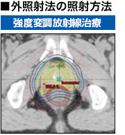 外照射法の照射方法