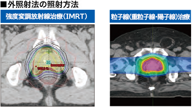 外照射法の照射方法