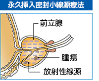 永久挿入密封小線源療法