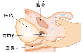直腸指診イメージ