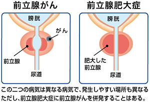 この二つの病気は異なる病気で、発生しやすい場所も異なる。ただし、前立腺肥大症に前立腺がんを併発することはある。