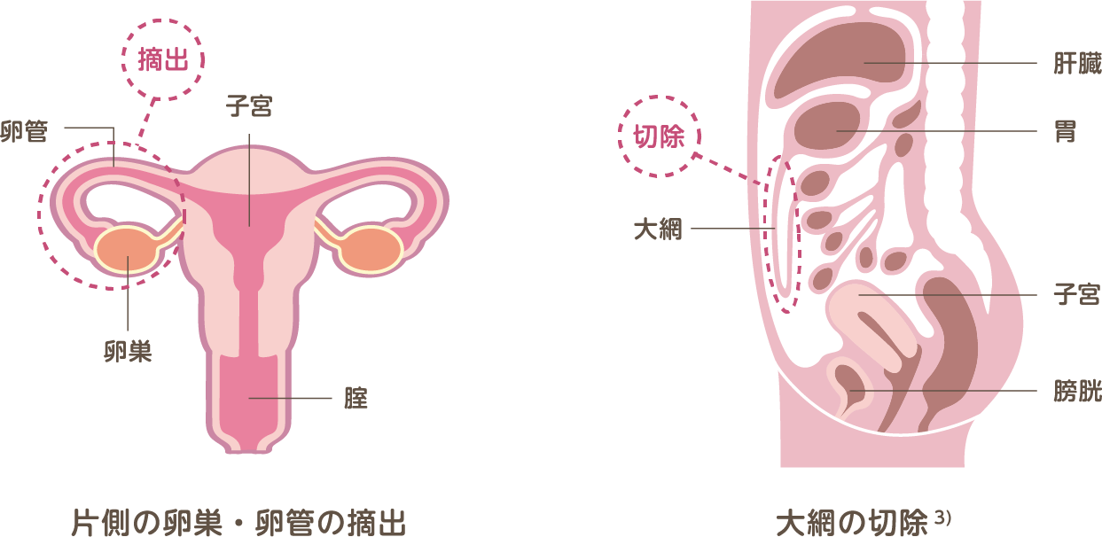 妊娠の機能を残す手術