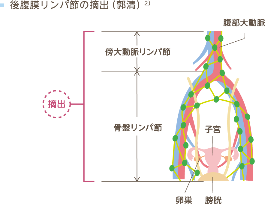 後腹膜リンパ節の摘出（郭清［かくせい］）