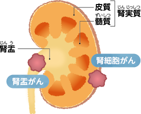 腎細胞がんと腎盂がん