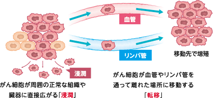 転移性腎細胞がんはどのようにして広がるのでしょうか?