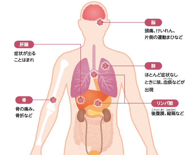 腎細胞がんの主な転移部位と転移による症状