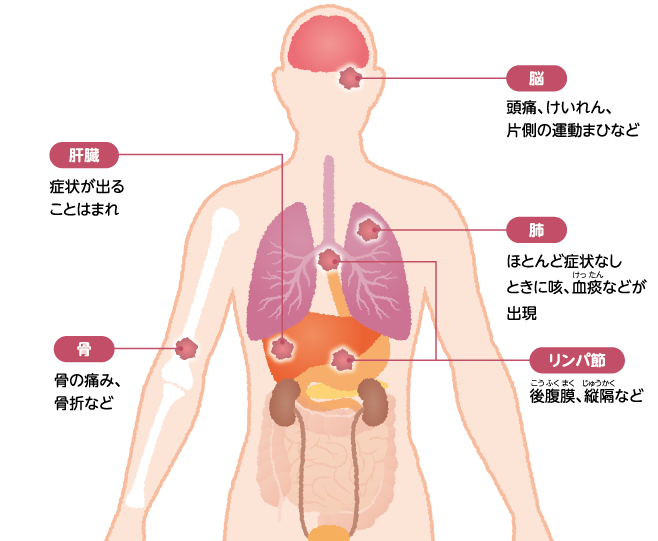 転移性腎細胞癌の症状