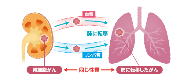 転移性腎細胞がん