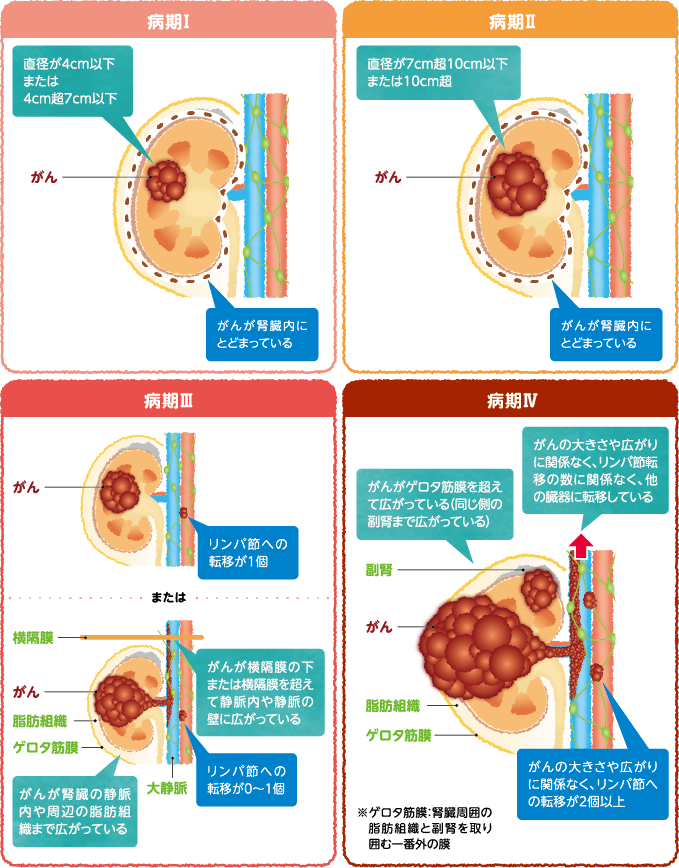 腎細胞がんの病期分類