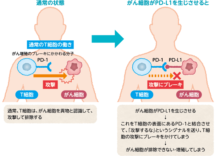 がん細胞がPD-L1を生じさせると